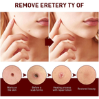 Liquid Wart and Skin Tag Removal