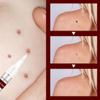 Liquid Wart and Skin Tag Removal
